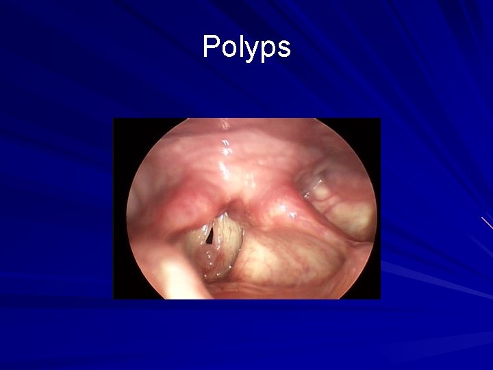 Polyps 