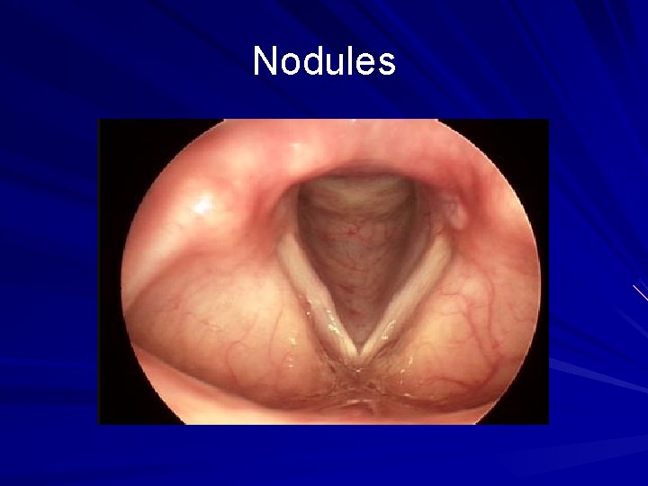 Nodules 