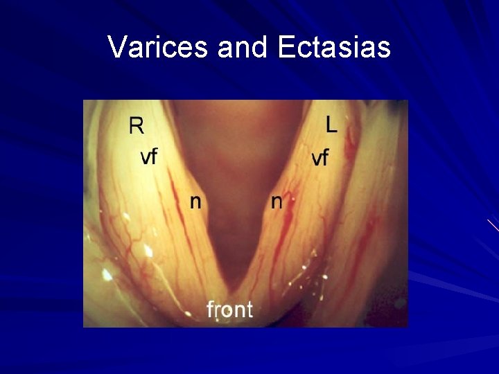 Varices and Ectasias 