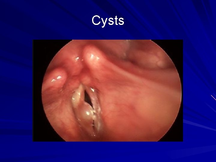 Cysts 