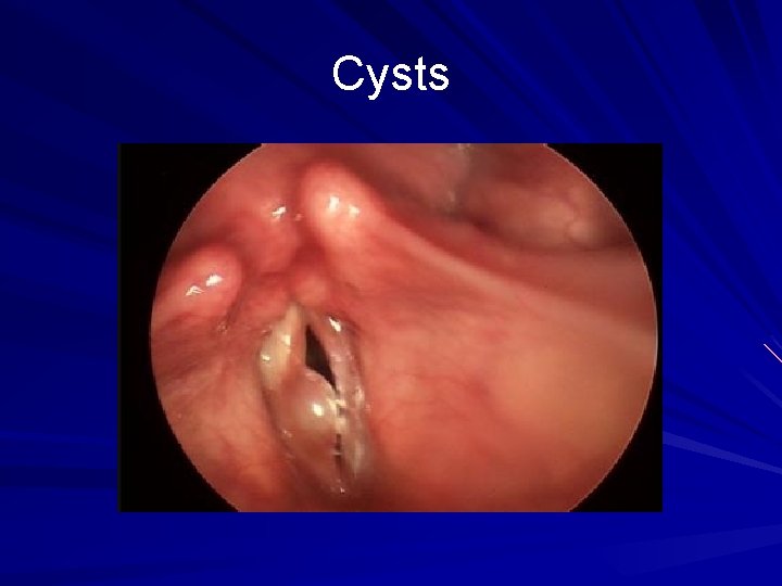 Cysts 