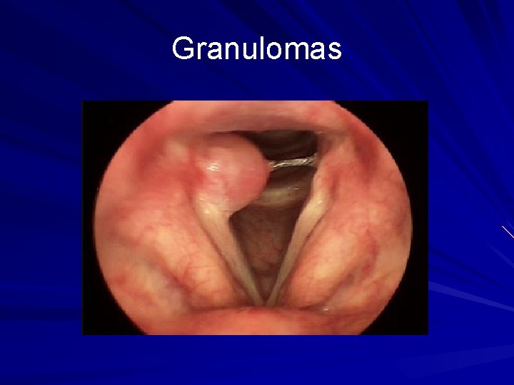 Granulomas 