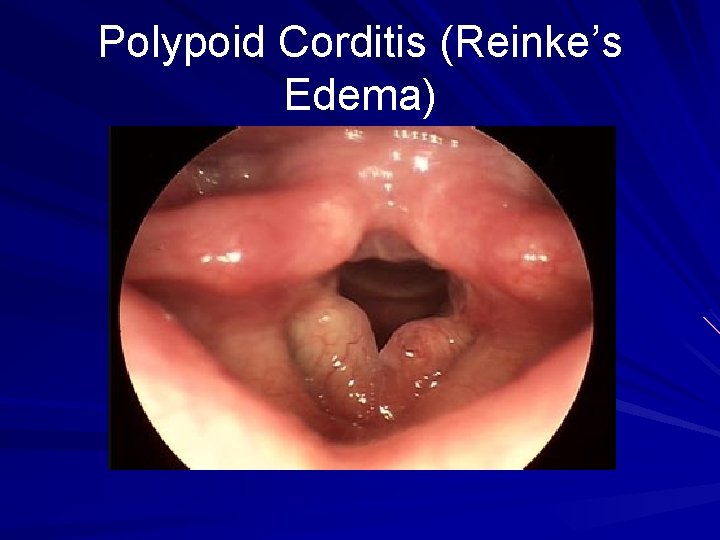 Polypoid Corditis (Reinke’s Edema) 