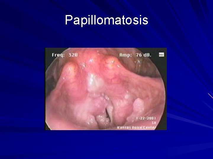 Papillomatosis 