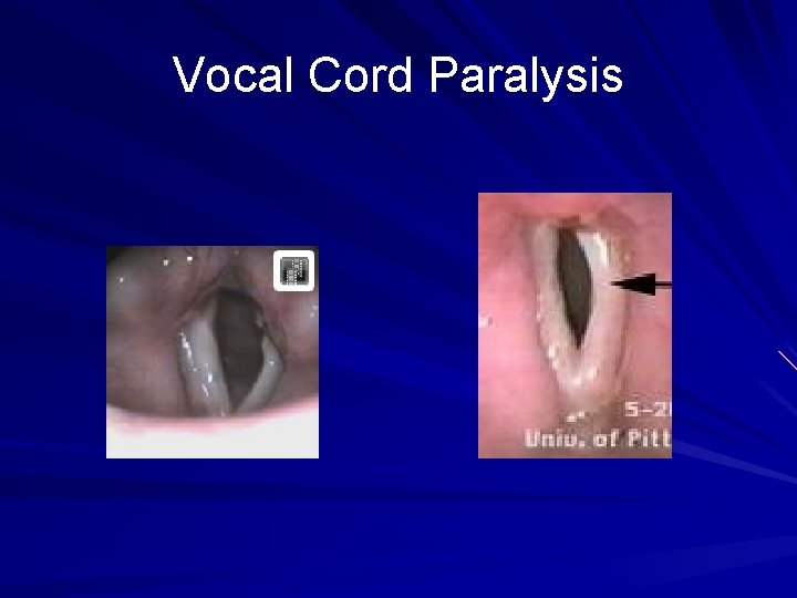 Vocal Cord Paralysis 