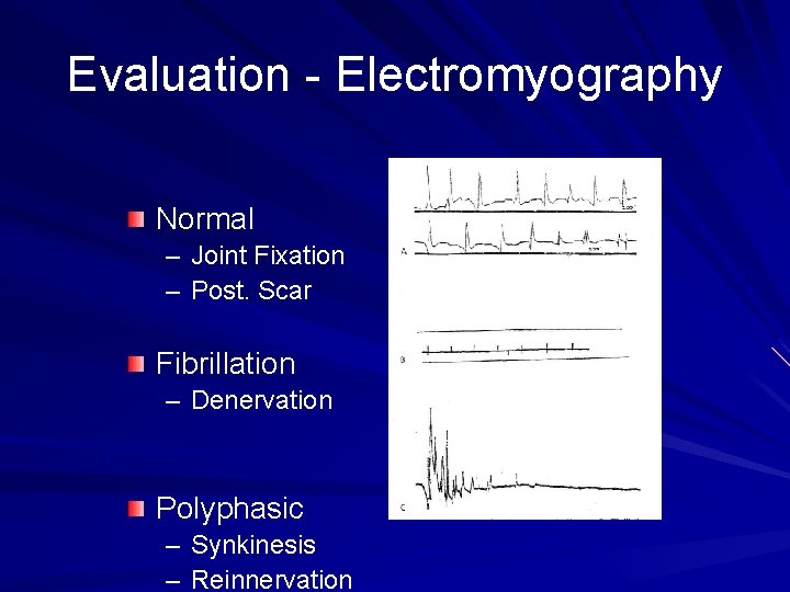 Evaluation - Electromyography Normal – Joint Fixation – Post. Scar Fibrillation – Denervation Polyphasic