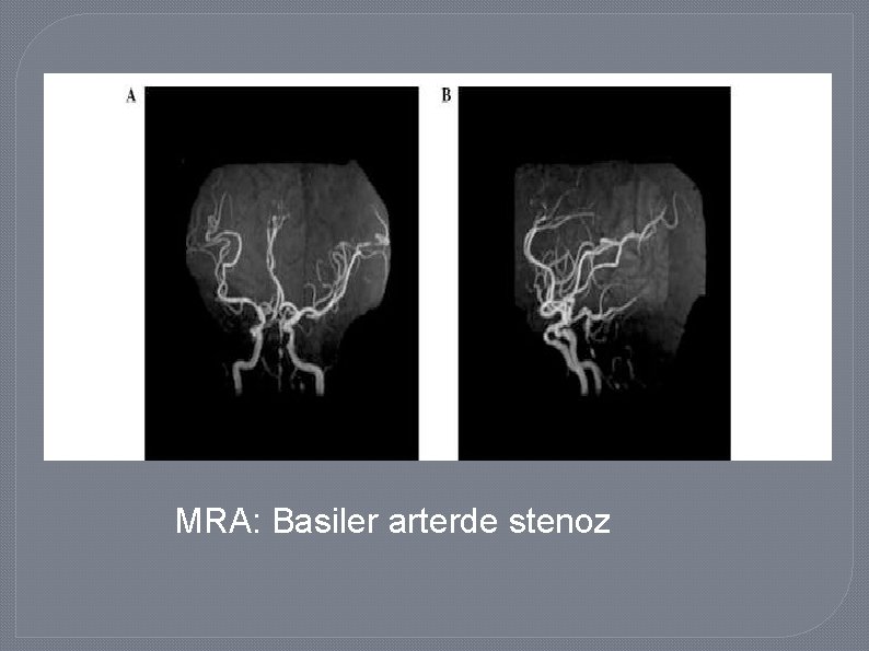 MRA: Basiler arterde stenoz 