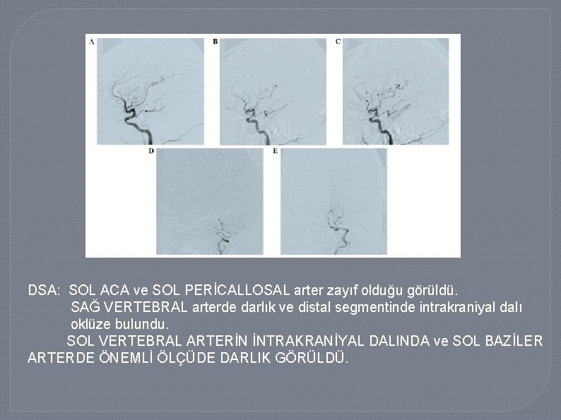 DSA: SOL ACA ve SOL PERİCALLOSAL arter zayıf olduğu görüldü. SAĞ VERTEBRAL arterde darlık