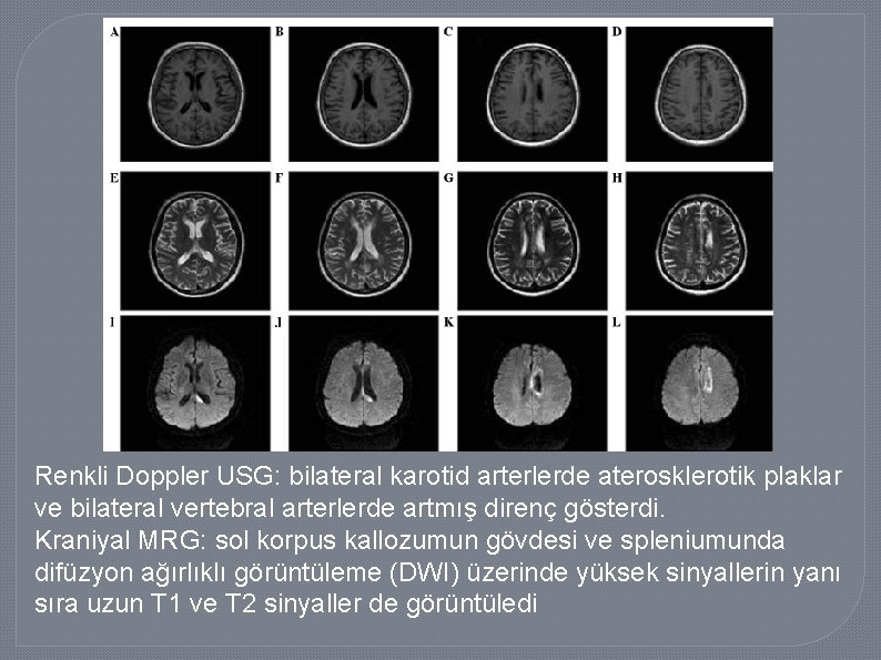 Renkli Doppler USG: bilateral karotid arterlerde aterosklerotik plaklar ve bilateral vertebral arterlerde artmış direnç