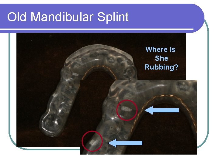 Old Mandibular Splint Where is She Rubbing? 