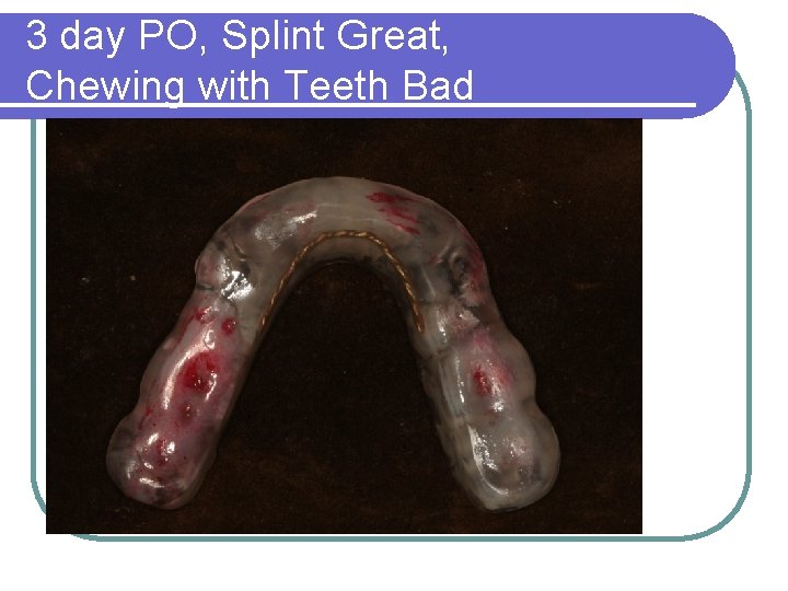 3 day PO, Splint Great, Chewing with Teeth Bad 