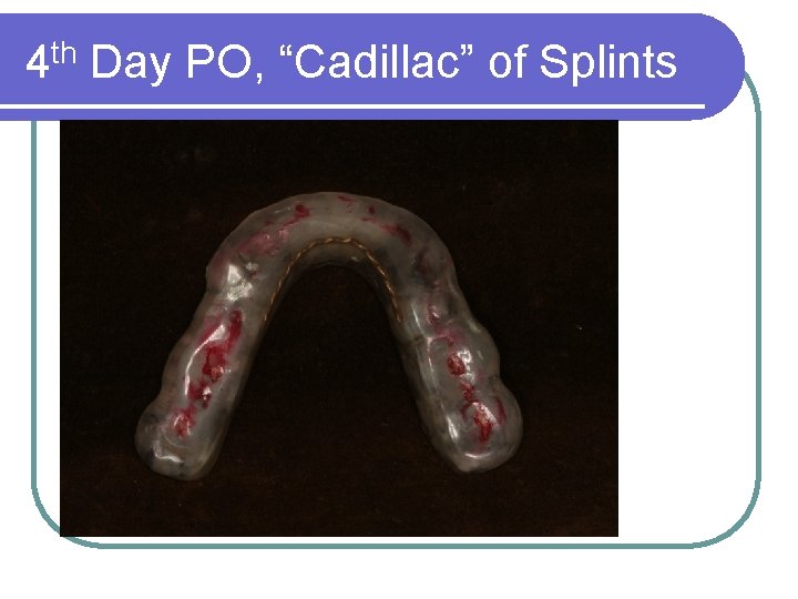 4 th Day PO, “Cadillac” of Splints 