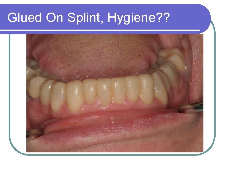 Glued On Splint, Hygiene? ? 