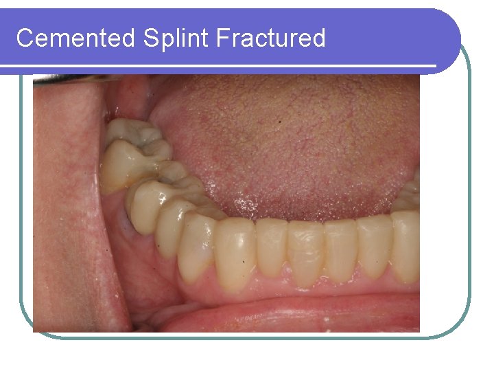 Cemented Splint Fractured 
