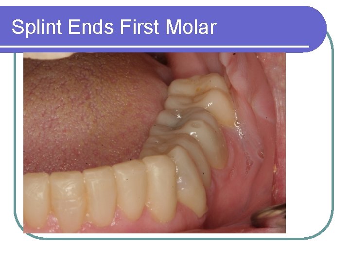 Splint Ends First Molar 
