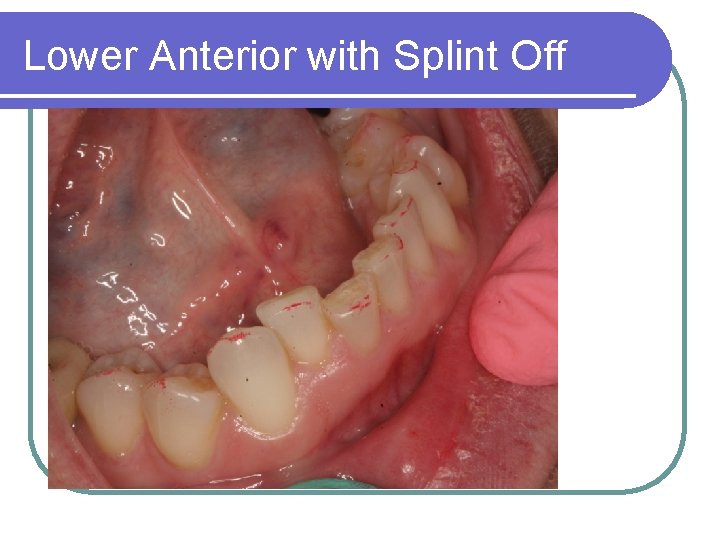 Lower Anterior with Splint Off 