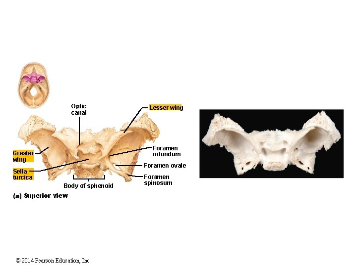Optic canal Lesser wing Foramen rotundum Greater wing Foramen ovale Sella turcica Body of