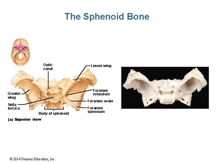 The Sphenoid Bone Optic canal Lesser wing Foramen rotundum Greater wing Foramen ovale Sella