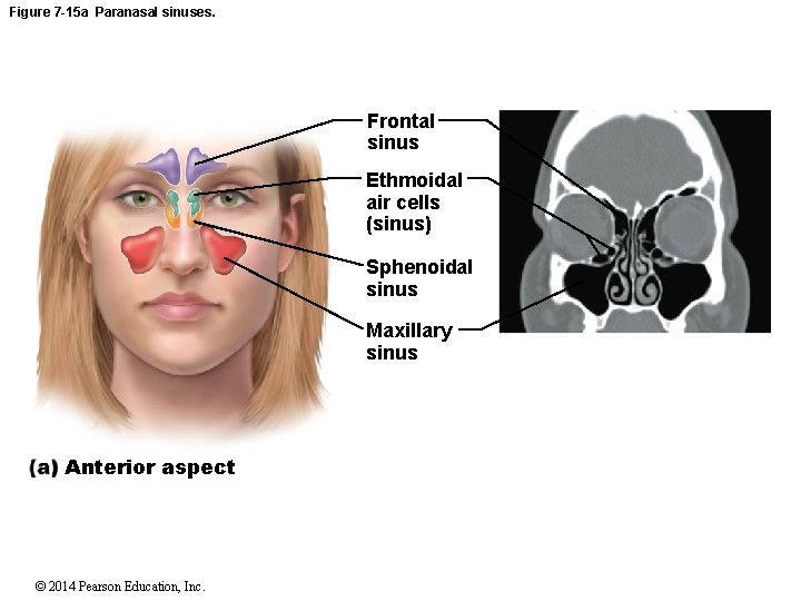 Figure 7 -15 a Paranasal sinuses. Frontal sinus Ethmoidal air cells (sinus) Sphenoidal sinus