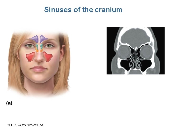 Sinuses of the cranium © 2014 Pearson Education, Inc. 