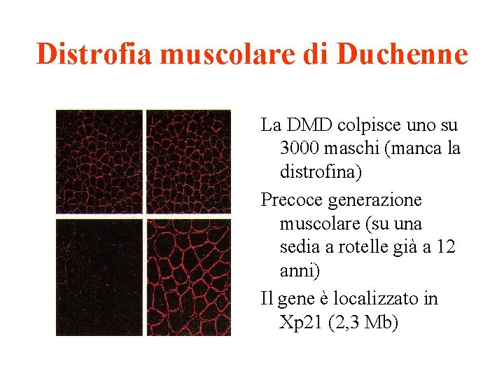 Distrofia muscolare di Duchenne La DMD colpisce uno su 3000 maschi (manca la distrofina)