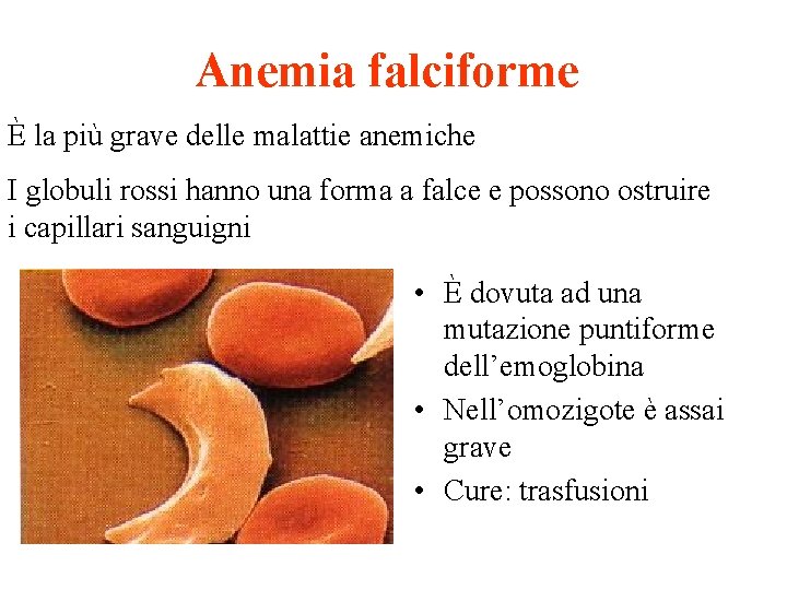 Anemia falciforme È la più grave delle malattie anemiche I globuli rossi hanno una