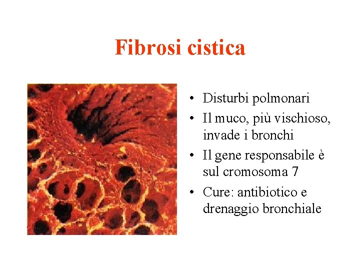 Fibrosi cistica • Disturbi polmonari • Il muco, più vischioso, invade i bronchi •