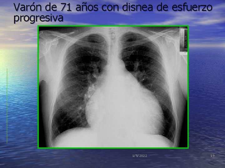 Varón de 71 años con disnea de esfuerzo progresiva 1/5/2022 19 Varón de 71 años con disnea de esfuerzo progresiva 1/5/2022 19
