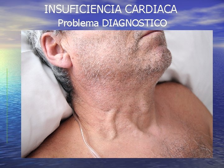 INSUFICIENCIA CARDIACA Problema DIAGNOSTICO INSUFICIENCIA CARDIACA Problema DIAGNOSTICO