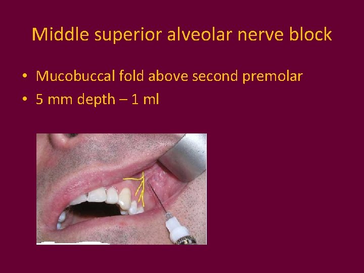 Middle superior alveolar nerve block • Mucobuccal fold above second premolar • 5 mm