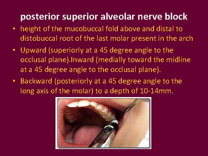 posterior superior alveolar nerve block • height of the mucobuccal fold above and distal