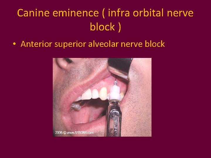 Canine eminence ( infra orbital nerve block ) • Anterior superior alveolar nerve block