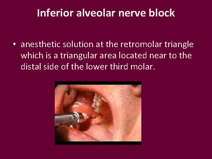 Inferior alveolar nerve block • anesthetic solution at the retromolar triangle which is a