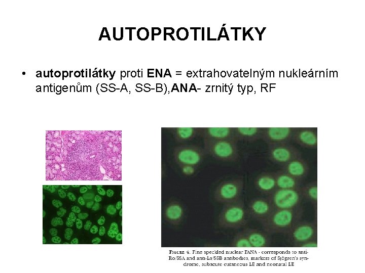 AUTOPROTILÁTKY • autoprotilátky proti ENA = extrahovatelným nukleárním antigenům (SS-A, SS-B), ANA- zrnitý typ,