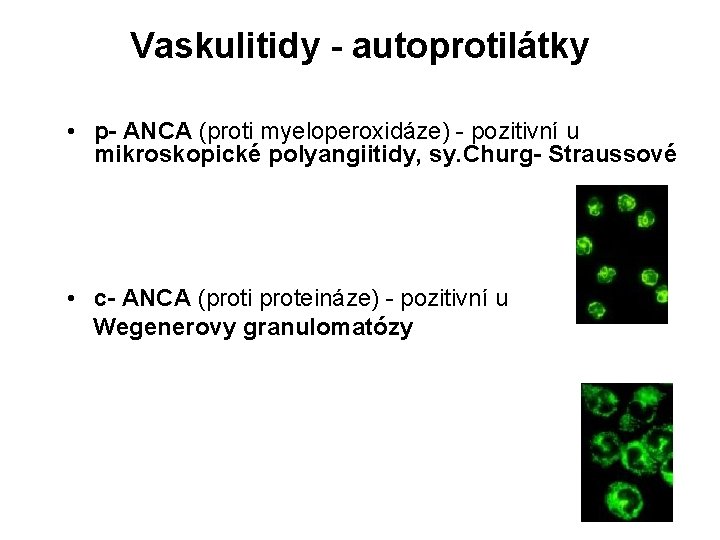 Vaskulitidy - autoprotilátky • p- ANCA (proti myeloperoxidáze) - pozitivní u mikroskopické polyangiitidy, sy.