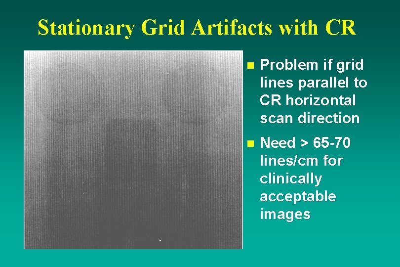 Stationary Grid Artifacts with CR n Problem if grid lines parallel to CR horizontal