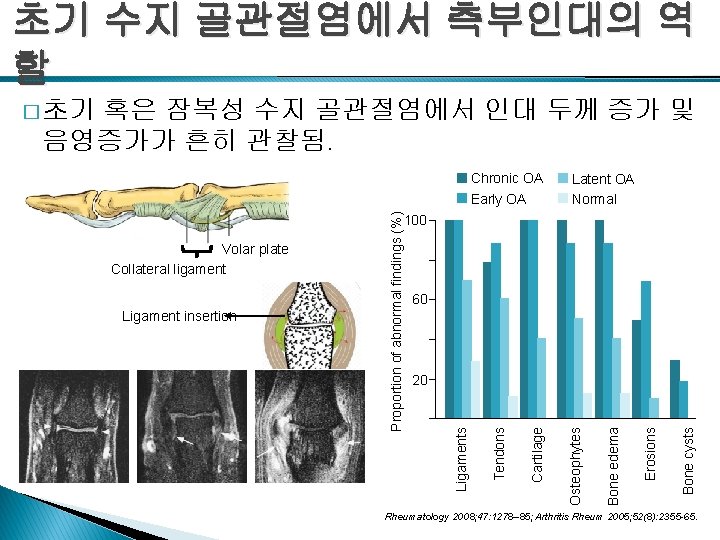 초기 수지 골관절염에서 측부인대의 역 할 � 초기 혹은 잠복성 수지 골관절염에서 인대 두께