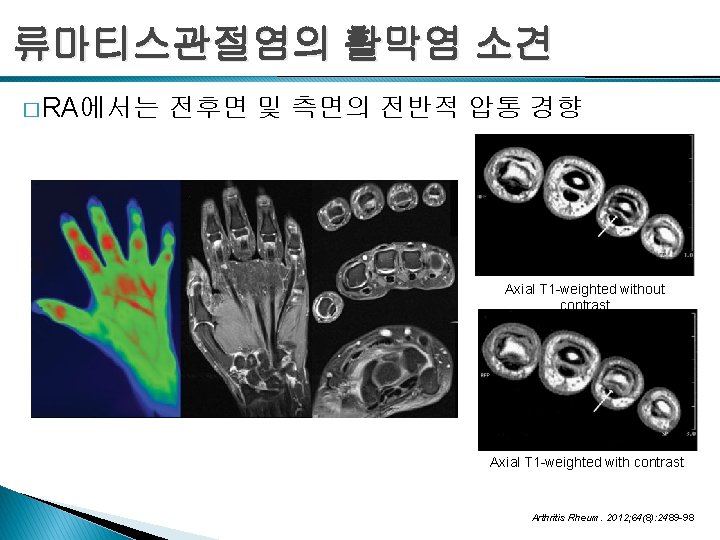 류마티스관절염의 활막염 소견 � RA에서는 전후면 및 측면의 전반적 압통 경향 Axial T 1