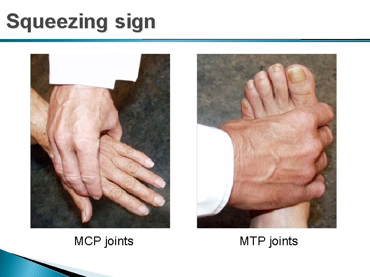 Squeezing sign MCP joints MTP joints 