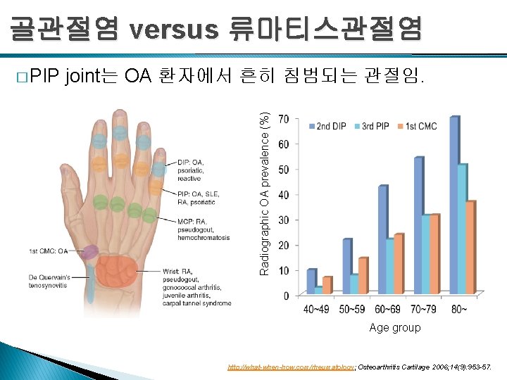 골관절염 versus 류마티스관절염 joint는 OA 환자에서 흔히 침범되는 관절임. Radiographic OA prevalence (%) �