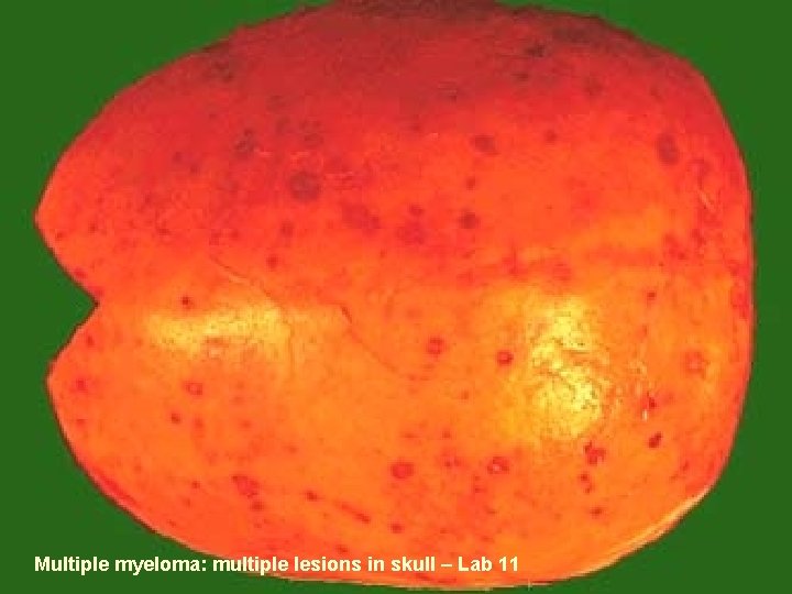 Multiple myeloma: multiple lesions in skull – Lab 11 