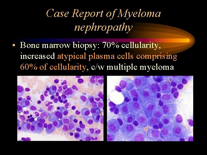 Case Report of Myeloma nephropathy • Bone marrow biopsy: 70% cellularity, increased atypical plasma