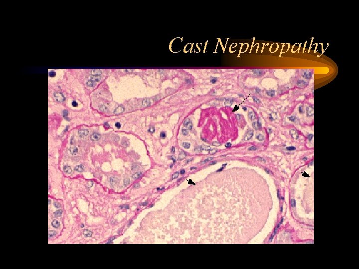 Cast Nephropathy 