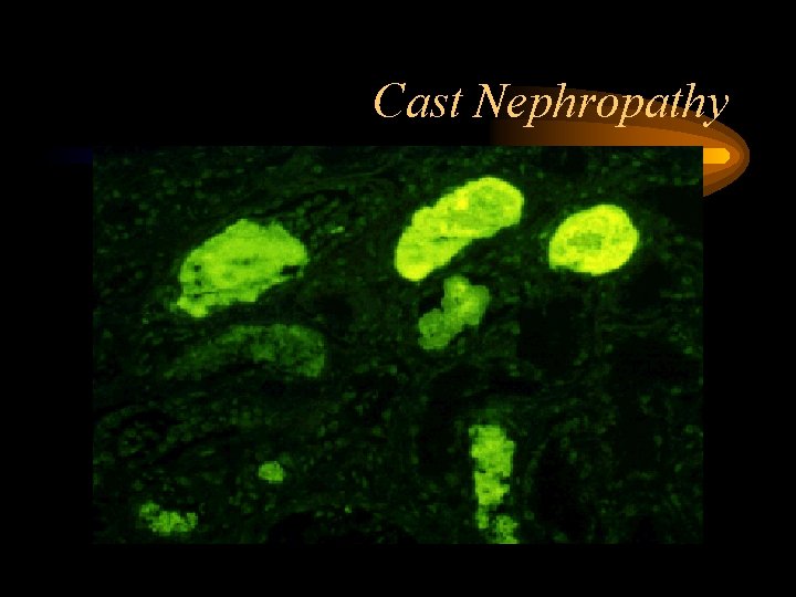 Cast Nephropathy 