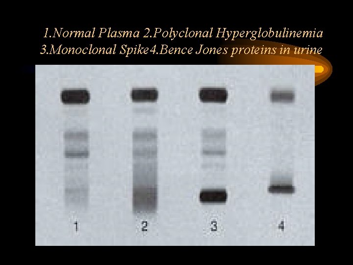 1. Normal Plasma 2. Polyclonal Hyperglobulinemia 3. Monoclonal Spike 4. Bence Jones proteins in