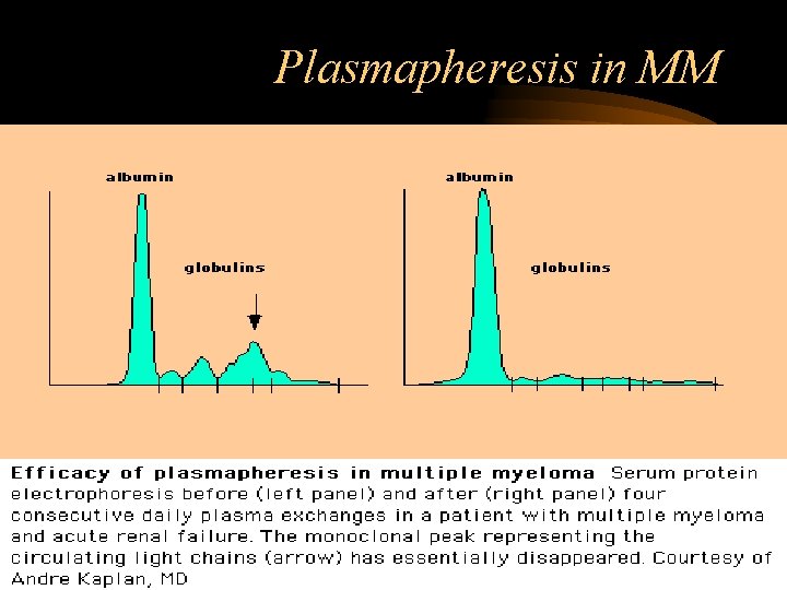 Plasmapheresis in MM 