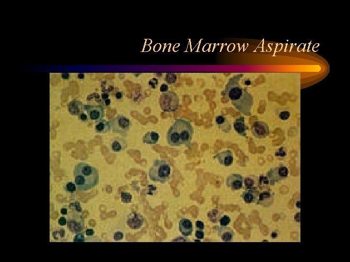 Bone Marrow Aspirate 
