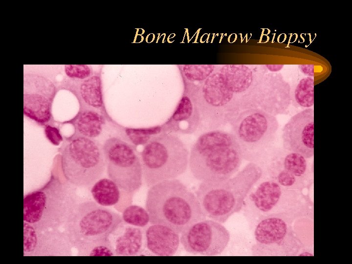 Bone Marrow Biopsy 