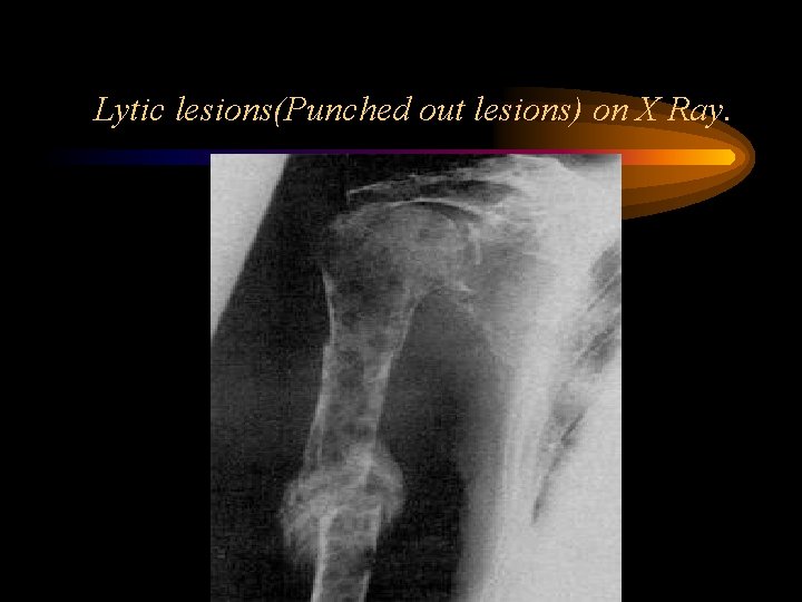 Lytic lesions(Punched out lesions) on X Ray. 