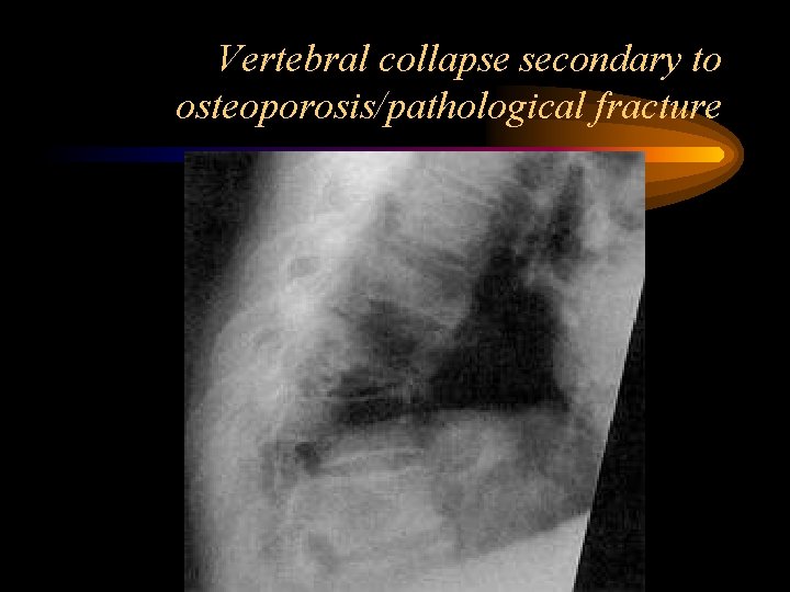 Vertebral collapse secondary to osteoporosis/pathological fracture 